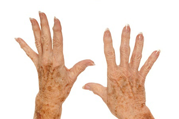 リウマチイメージ